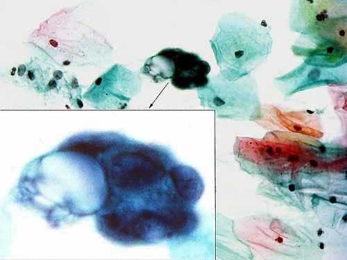 Uterine Cervix Pap smear - 400x